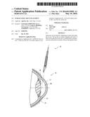 INTRASCLERAL SHUNT PLACEMENT diagram and image