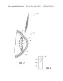 INTRASCLERAL SHUNT PLACEMENT diagram and image