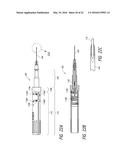 INTRASCLERAL SHUNT PLACEMENT diagram and image