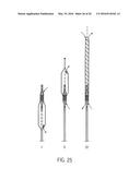 CATHETER DEVICE diagram and image