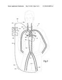 POST MORTEM RECONSTITUTION OF CIRCULATION diagram and image