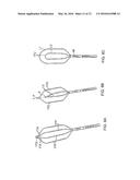 CATHETER WITH HIGH DENSITY ELECTRODE SPINE ARRAY diagram and image