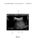 ELASTOGRAPHY MEASUREMENT SYSTEM AND METHOD diagram and image