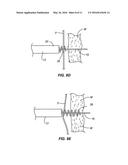 METHOD AND APPARATUS FOR TRANSAPICAL ACCESS AND CLOSURE diagram and image