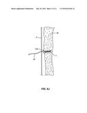 METHOD AND APPARATUS FOR TRANSAPICAL ACCESS AND CLOSURE diagram and image