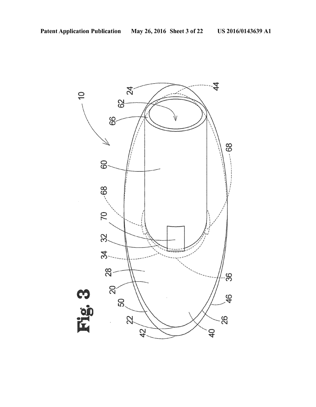 VASCULAR ANASTOMOSIS DEVICE AND METHOD - diagram, schematic, and image 04