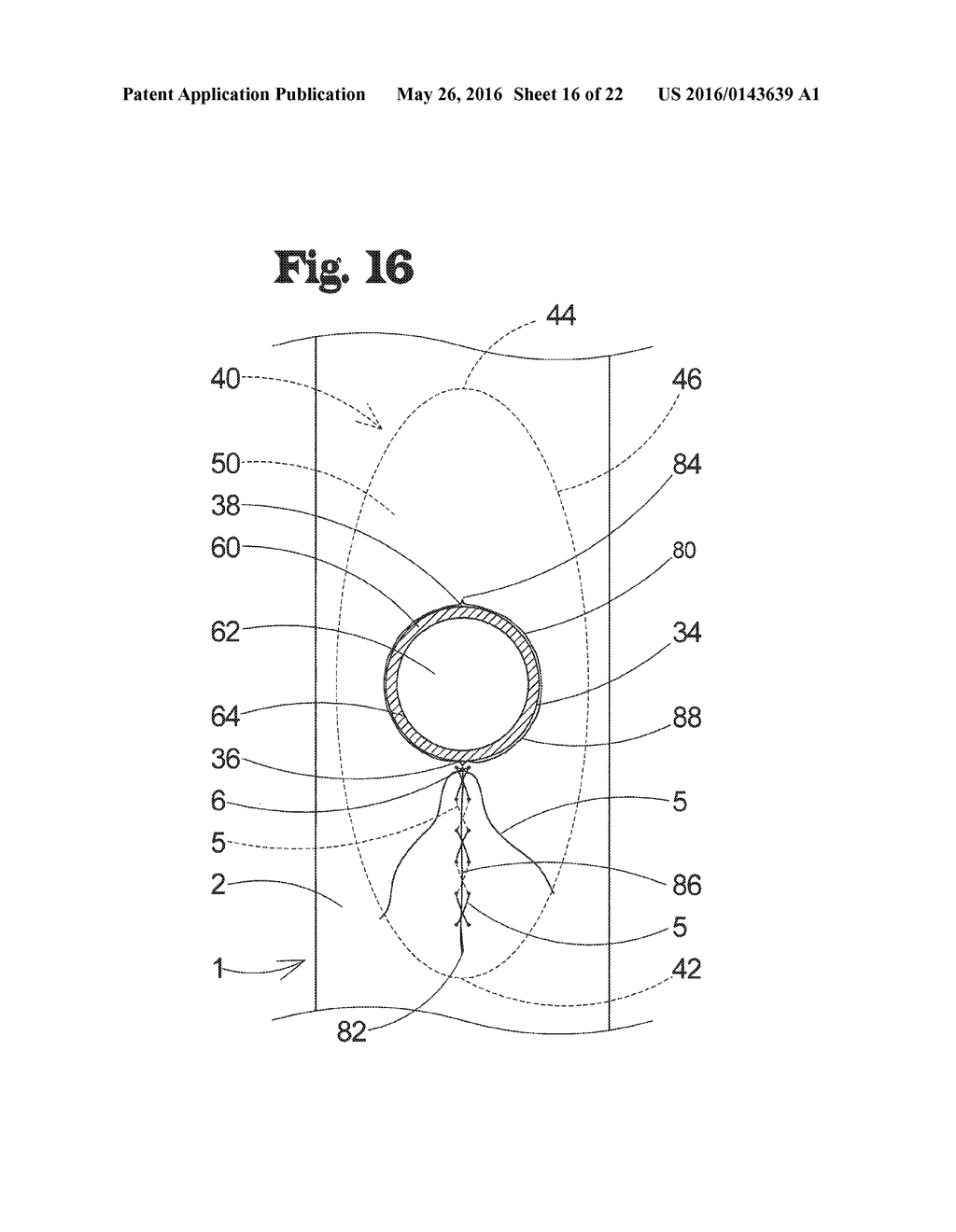 VASCULAR ANASTOMOSIS DEVICE AND METHOD - diagram, schematic, and image 17