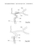 CLOT RETRIEVAL DEVICE FOR REMOVING OCCLUSIVE CLOT FROM A BLOOD VESSEL diagram and image