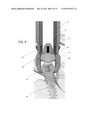 MINIMALLY-INVASIVE SURGERY PEDICLE SCREW AND ROD ASSEMBLY, INSERTER TOOL,     AND INSERTION METHOD FOR USE IN SPINAL STABILIZATION PROCEDURES diagram and image