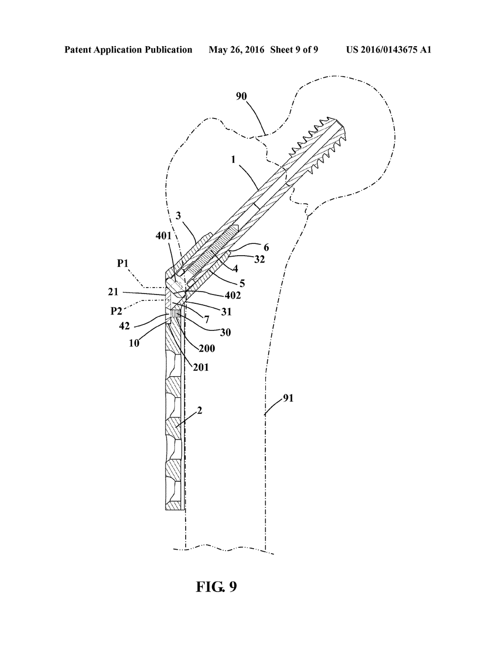 REAR-RETAINING STRUCTURE FOR DYNAMIC HIP SCREW - diagram, schematic, and image 10