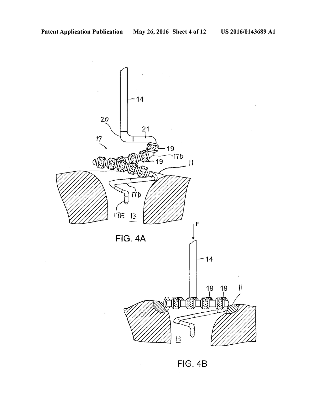 CATHETER WITH SOFT DISTAL TIP FOR MAPPING AND ABLATING TUBULAR REGION - diagram, schematic, and image 05