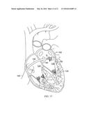 CATHETER WITH SOFT DISTAL TIP FOR MAPPING AND ABLATING TUBULAR REGION diagram and image