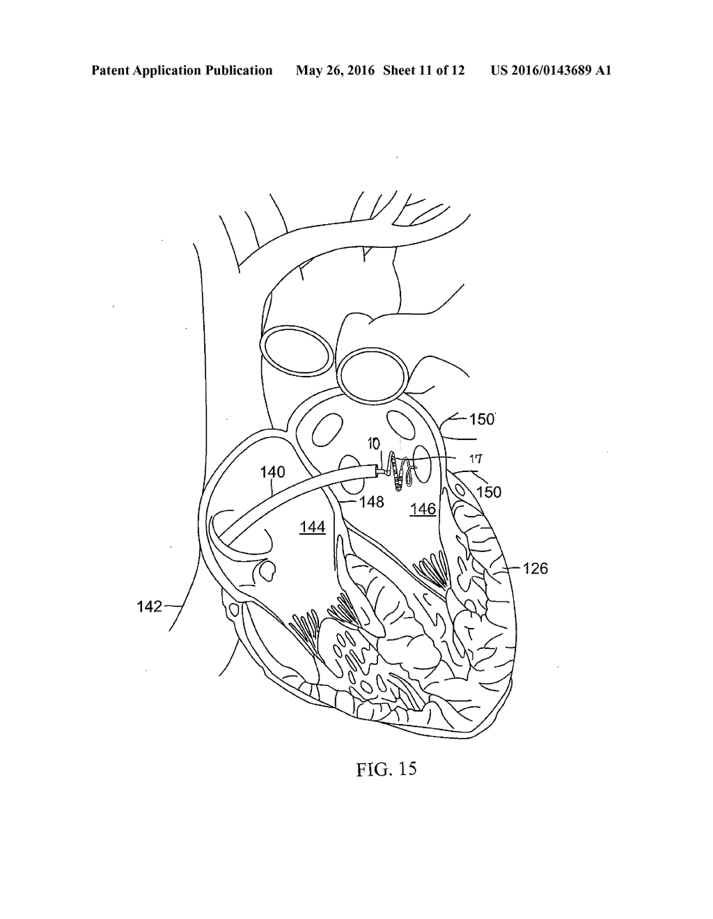 CATHETER WITH SOFT DISTAL TIP FOR MAPPING AND ABLATING TUBULAR REGION - diagram, schematic, and image 12