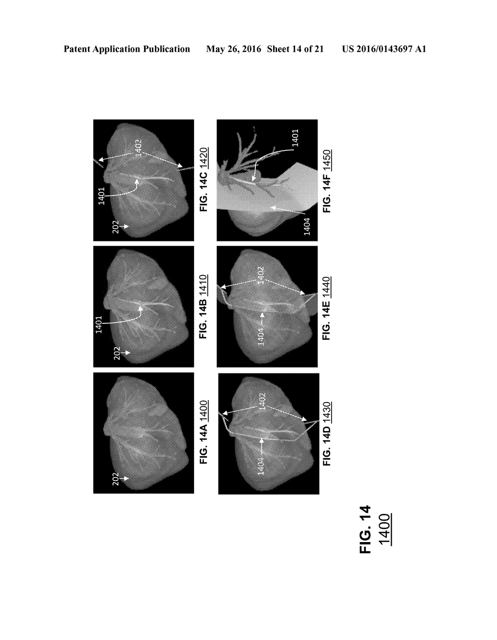 COMPUTER-AIDED PLANNING OF LIVER SURGERY - diagram, schematic, and image 15