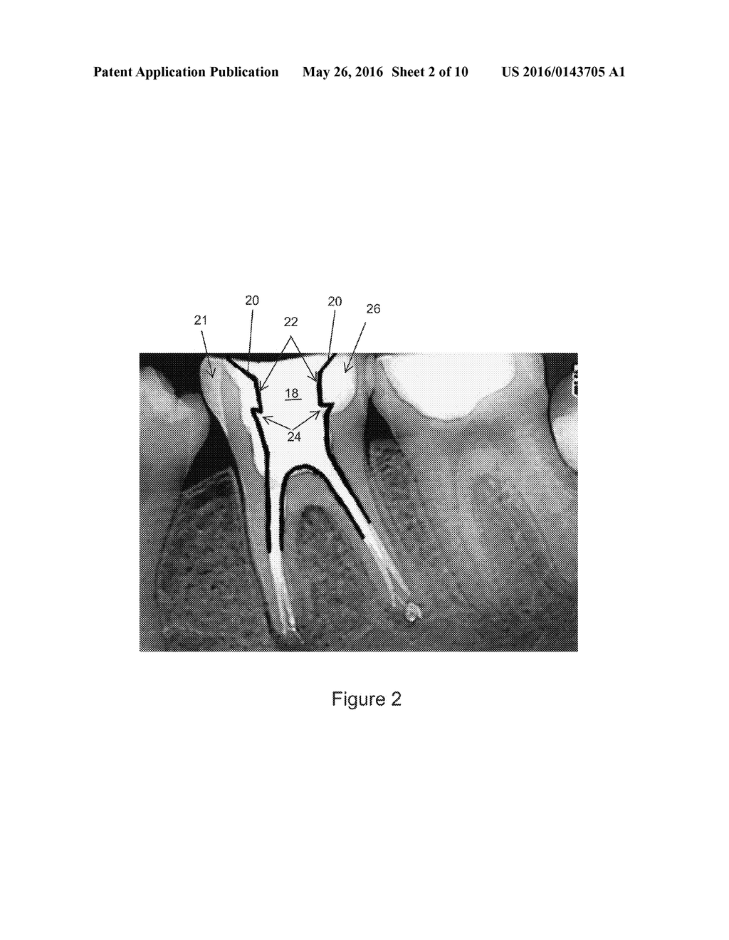 Methods and Devices for Treating Root Canals of Teeth - diagram, schematic, and image 03