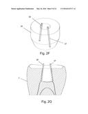 A METHOD AND SYSTEM FOR THE MANUFACTURING OF AN ORAL TEMPLATE FROM A 3D     DIGITAL DATA diagram and image