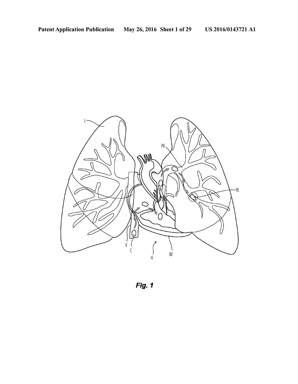 METHODS AND APPARATUS FOR TREATING PULMONARY EMBOLISM - diagram, schematic, and image 02