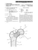 FEMORAL NECK SUPPORT STRUCTURE, SYSTEM, AND METHOD OF USE diagram and image