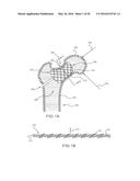 FEMORAL NECK SUPPORT STRUCTURE, SYSTEM, AND METHOD OF USE diagram and image