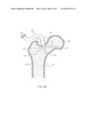 FEMORAL NECK SUPPORT STRUCTURE, SYSTEM, AND METHOD OF USE diagram and image