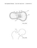 FEMORAL NECK SUPPORT STRUCTURE, SYSTEM, AND METHOD OF USE diagram and image