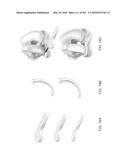 Patient-Adapted and Improved Articular Implants, Designs and Related Guide     Tools diagram and image