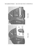 Patient-Adapted and Improved Articular Implants, Designs and Related Guide     Tools diagram and image