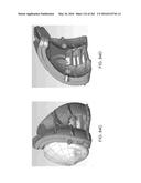 Patient-Adapted and Improved Articular Implants, Designs and Related Guide     Tools diagram and image