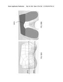 Patient-Adapted and Improved Articular Implants, Designs and Related Guide     Tools diagram and image