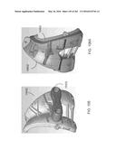 Patient-Adapted and Improved Articular Implants, Designs and Related Guide     Tools diagram and image