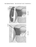 Patient-Adapted and Improved Articular Implants, Designs and Related Guide     Tools diagram and image