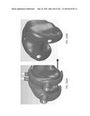 Patient-Adapted and Improved Articular Implants, Designs and Related Guide     Tools diagram and image