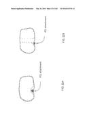 Patient-Adapted and Improved Articular Implants, Designs and Related Guide     Tools diagram and image