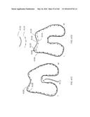 Patient-Adapted and Improved Articular Implants, Designs and Related Guide     Tools diagram and image