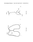 Patient-Adapted and Improved Articular Implants, Designs and Related Guide     Tools diagram and image