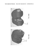 Patient-Adapted and Improved Articular Implants, Designs and Related Guide     Tools diagram and image