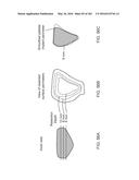 Patient-Adapted and Improved Articular Implants, Designs and Related Guide     Tools diagram and image
