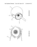 A DEVICE FOR DELIVERY OF COMPOSITIONS TO THE EYE diagram and image