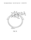 AQUABLATION AQUABEAM EYE SURGERY METHODS AND APPARATUS diagram and image