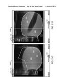 AQUABLATION AQUABEAM EYE SURGERY METHODS AND APPARATUS diagram and image