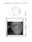 AQUABLATION AQUABEAM EYE SURGERY METHODS AND APPARATUS diagram and image