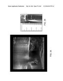 AQUABLATION AQUABEAM EYE SURGERY METHODS AND APPARATUS diagram and image