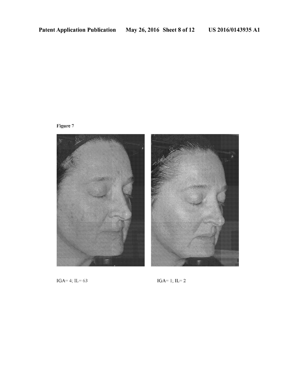 TREATMENT OF INFLAMMATORY LESIONS OF ROSACEA WITH IVERMECTIN - diagram, schematic, and image 09