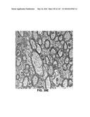 Methods and Treatment for Certain Demyelination and Dysmyelination-Based     Disorders and/or Promoting Remyelination diagram and image