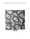 Methods and Treatment for Certain Demyelination and Dysmyelination-Based     Disorders and/or Promoting Remyelination diagram and image