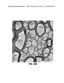 Methods and Treatment for Certain Demyelination and Dysmyelination-Based     Disorders and/or Promoting Remyelination diagram and image