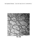 Methods and Treatment for Certain Demyelination and Dysmyelination-Based     Disorders and/or Promoting Remyelination diagram and image