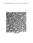 Methods and Treatment for Certain Demyelination and Dysmyelination-Based     Disorders and/or Promoting Remyelination diagram and image