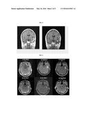 TREATMENT OF BRAIN CANCER WITH ONCOLYTIC ADENOVIRUS diagram and image