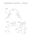 SYSTEMS, DEVICES, AND METHOD FOR TREATING A SINUS CONDITION diagram and image